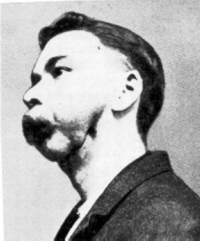 Several diseases came out including "phossy jaw"