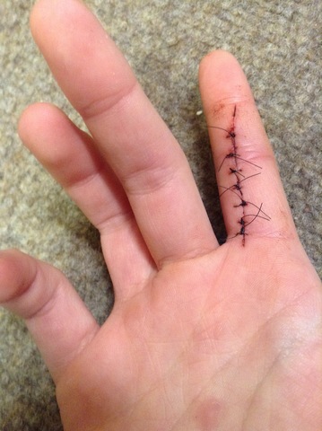 first time i got stiches