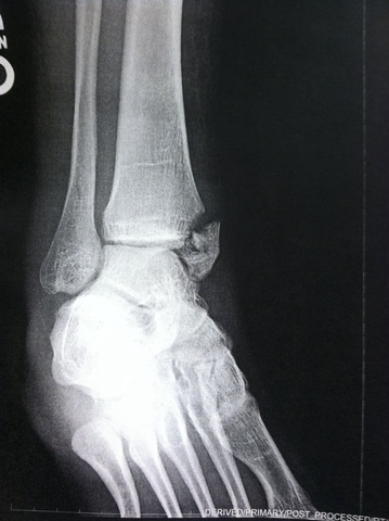 Broke Ankle