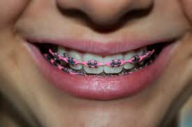 GOT BRACES