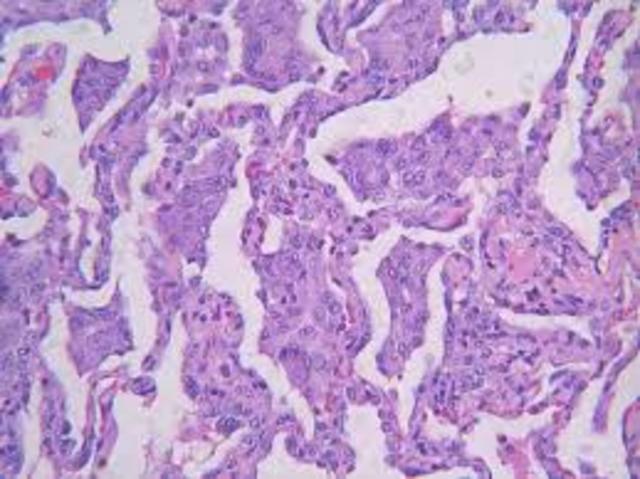 Aparece en China la neumonía atípica (síndrome respiratorio agudo, SARS), enfermedad respiratoria producida por un coronavirus