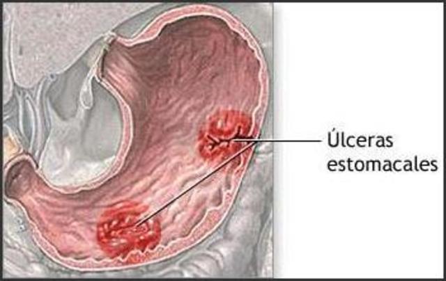 úlcera de estómago