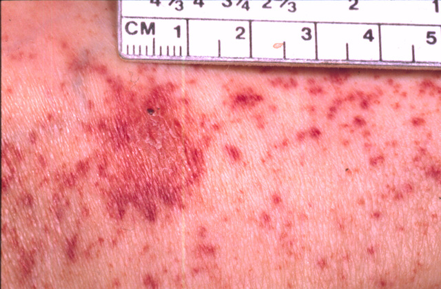 Howard Taylor Ricketts