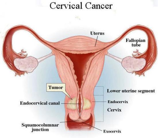 vaccine to prevent cervical cancer