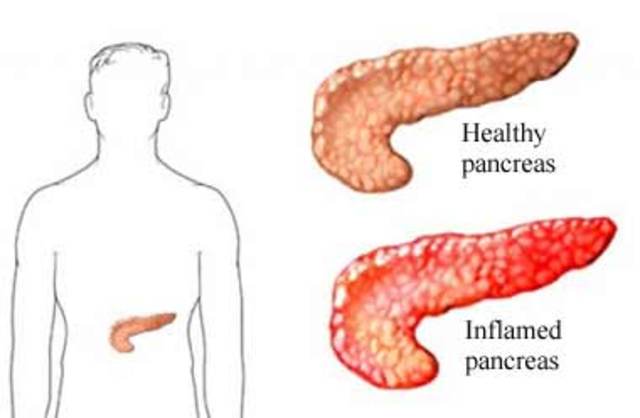I had Pancreatitis