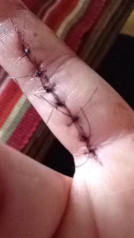 First Stiches