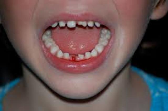 Lost first tooth