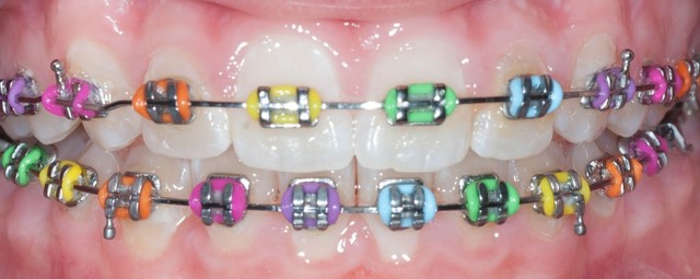 Braces