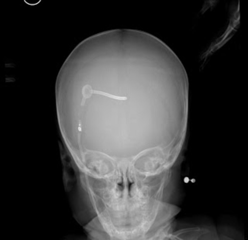 LA VÁLVULA DE HAKIM: TECNOLOGÍA COLOMBIANA PARA TRATAR LA HIDROCEFALIA