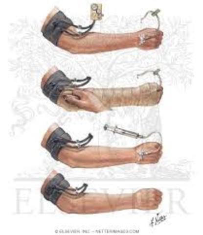 Bloqueo endovenoso de Bier