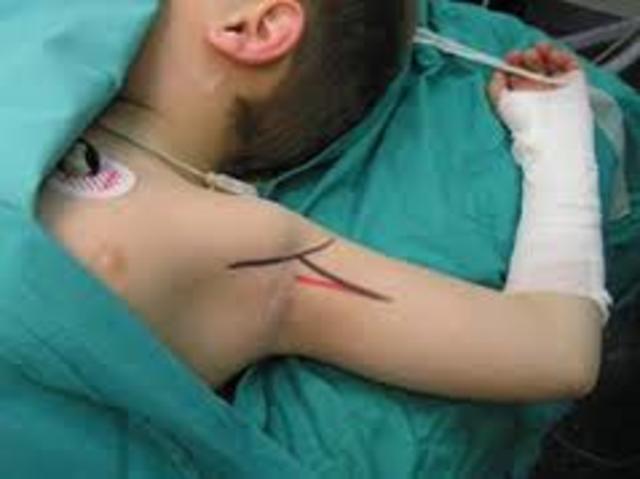 Bloqueos de miembro superior