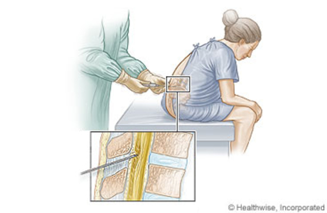 Bloqueo en silla de montar