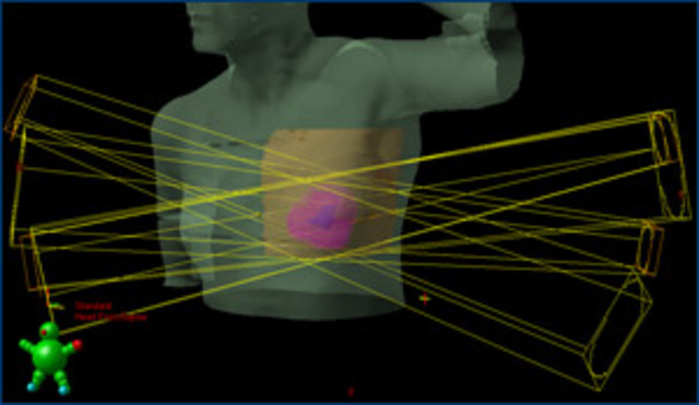 Shift to 3-D radiation treatment plan increases precision, safety of therapy