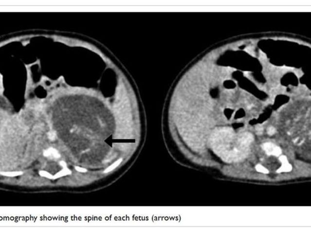 Girl born pregnant with twin fetuses