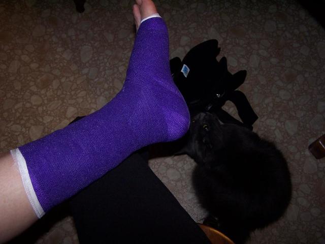 Broken bone number #1