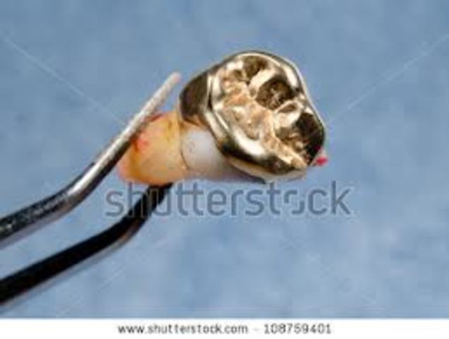 Extracted gold crown