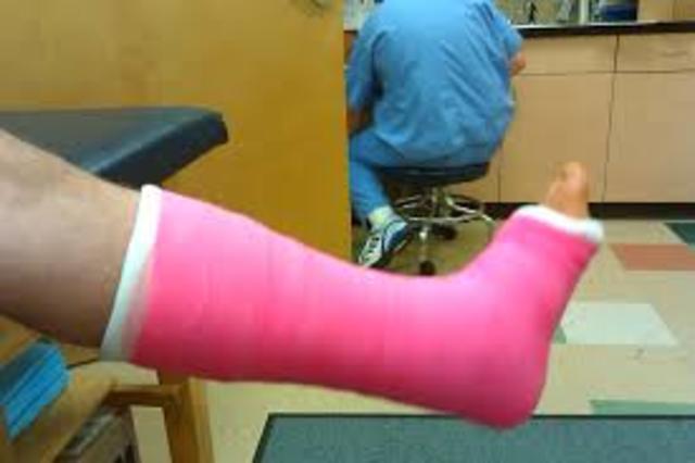 Broken Bone #2