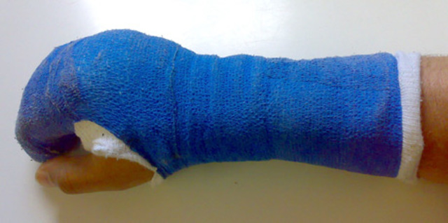 Broke my hand