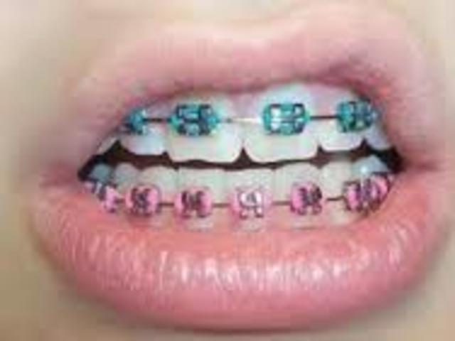 Braces