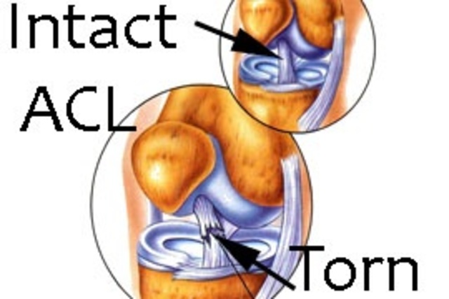 Cuando mi rasgue mi ACL