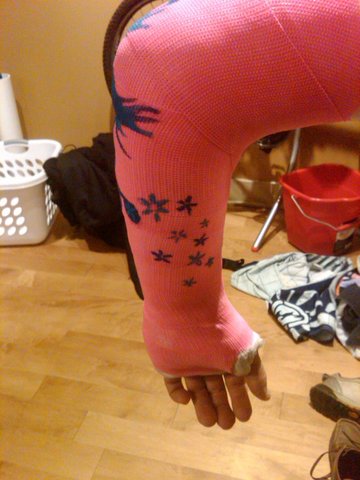 broken arm #2