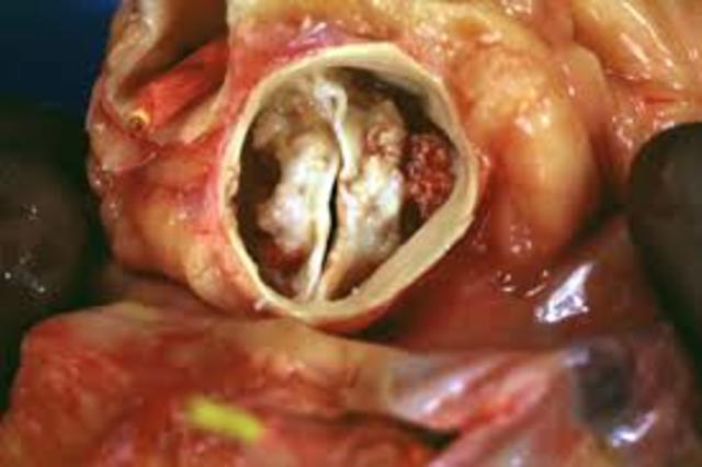 Bicuspid (Mitral) Valve