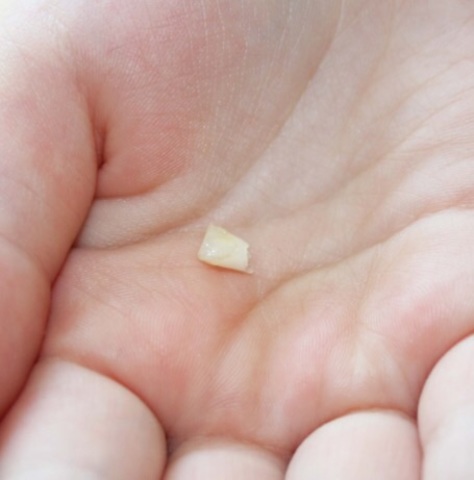 I Lost My First Tooth