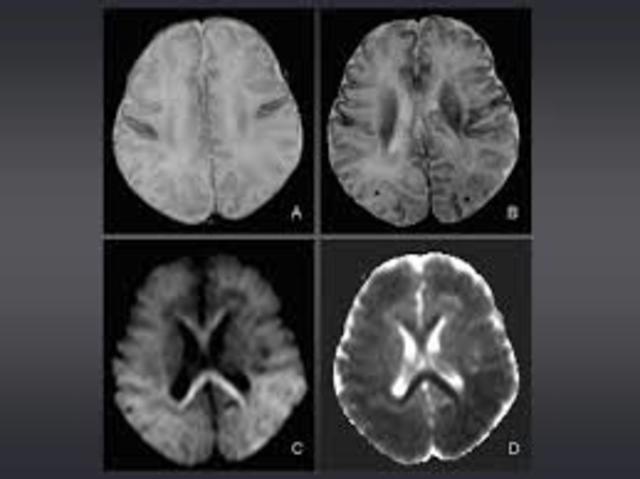 Sindrome de desconexión