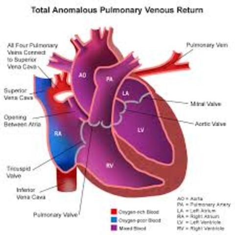 Pulmonary Vein and Left Atrium