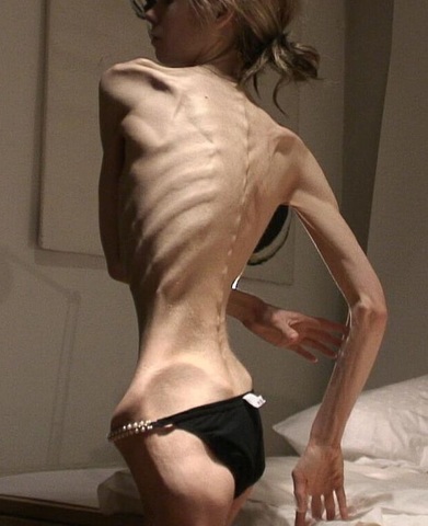 Se nombro anorexia