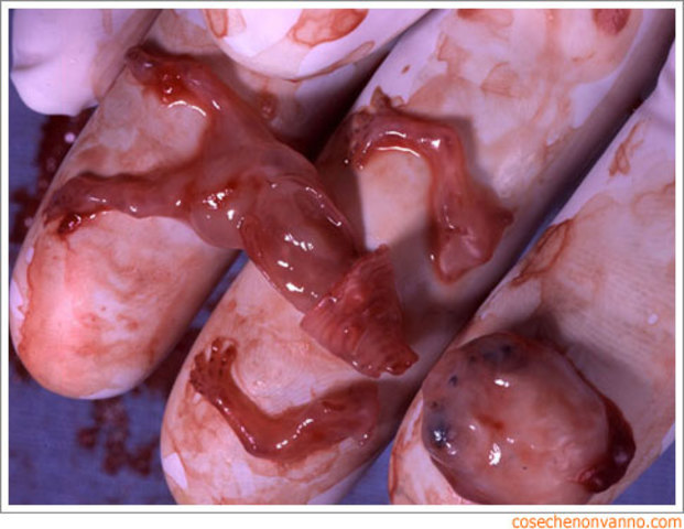 POR TODO LO ANTERIOR, DECIDO ABORTAR.