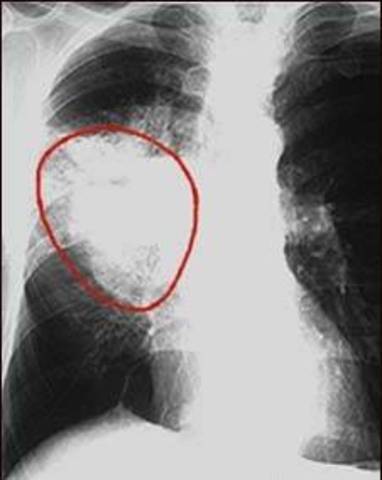 Leukaemia considered an incurable disease