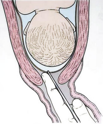Early signs of labor