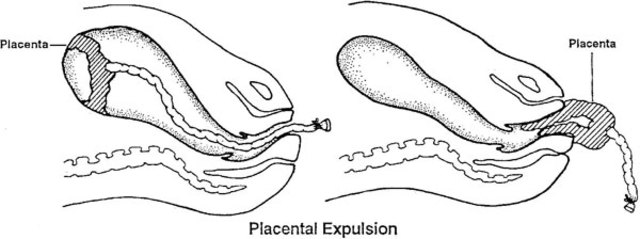 Third stage of labor