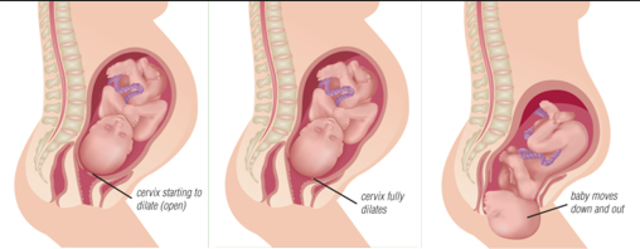 Early signs of labor- First Stage
