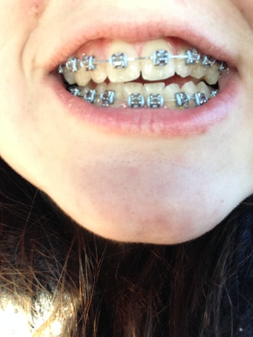 Got Braces