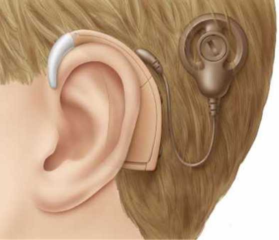 Bionic Ear