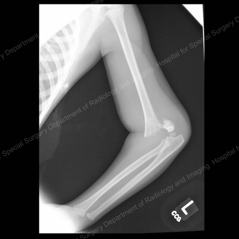 The day I broke my elbow