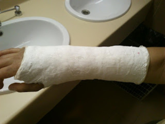 Mi primera rotura de brazo