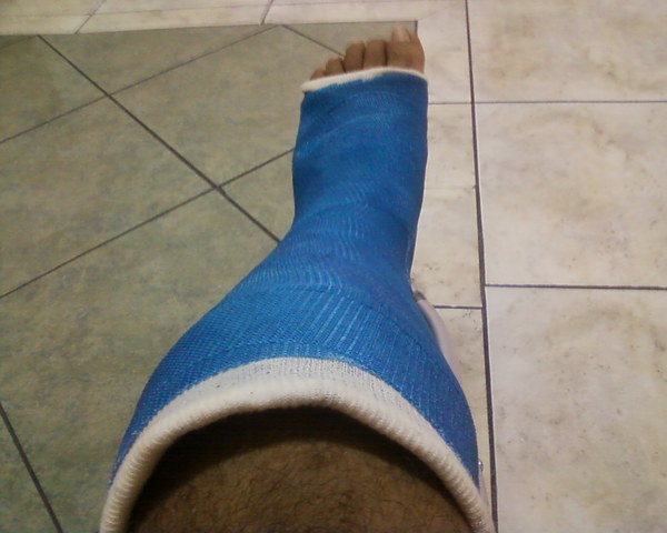Fractura de pie izquierdo