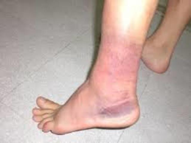 Lesion de Volleyball