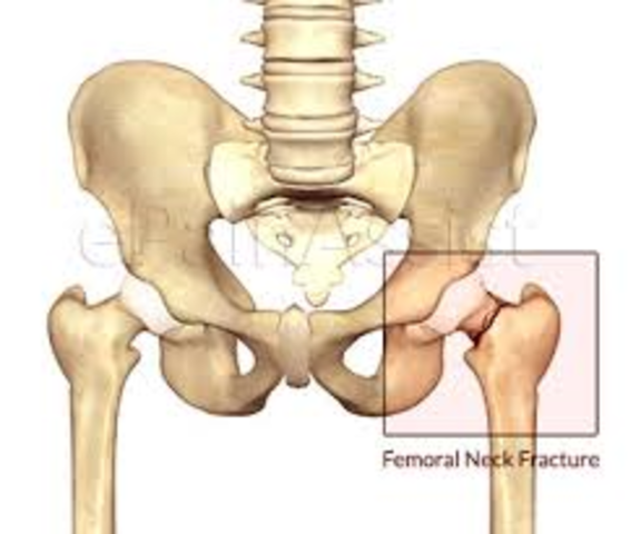 Fractured my hip