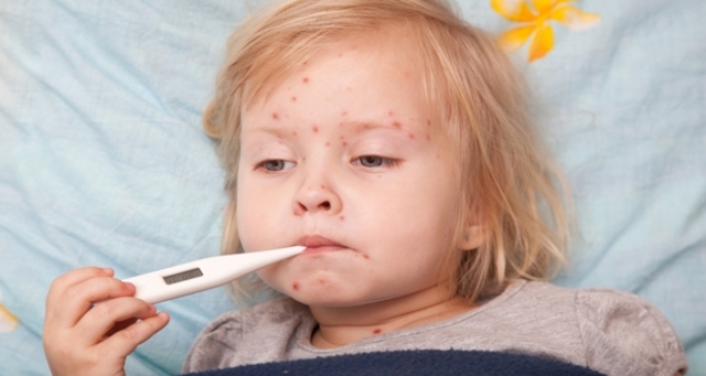 Chicken Pox
