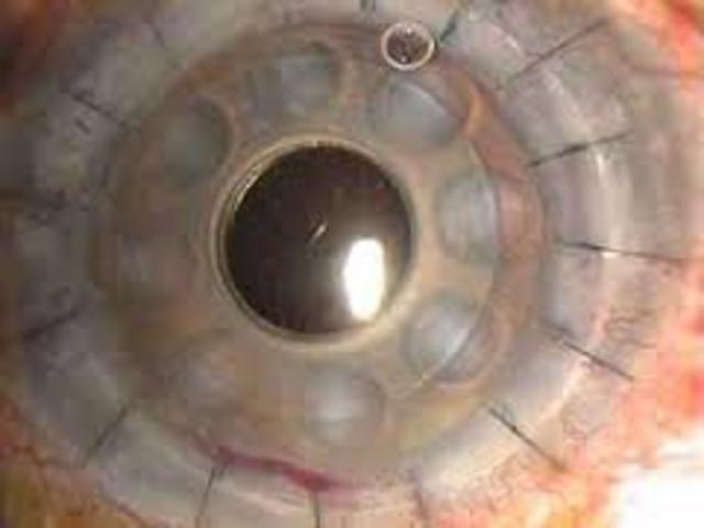 PRIMERA CORNEA ARTIFICIAL COMPLETA