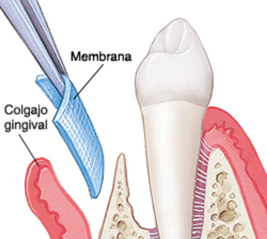 REGENERACION TISULAR