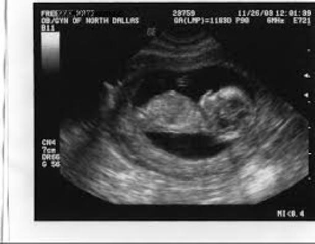 Week 11 of pregnancy