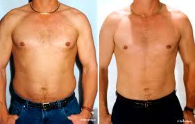 Liposuction