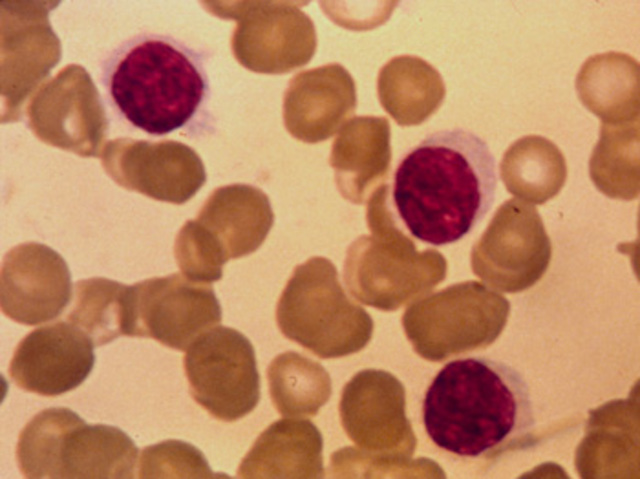 Moore v. Regents of the University of California desicion made