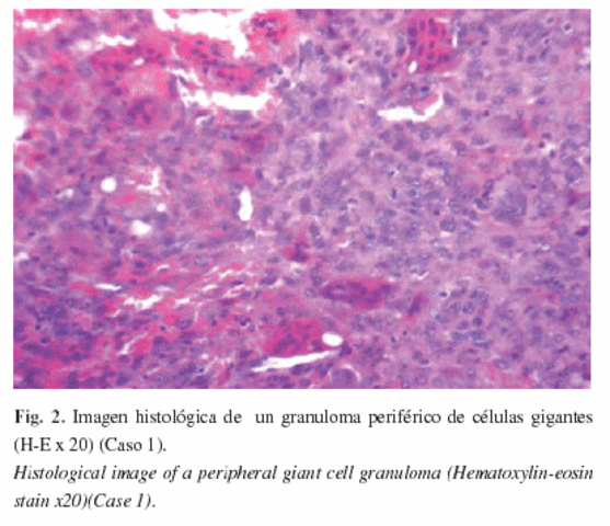 Estudio granuloma
