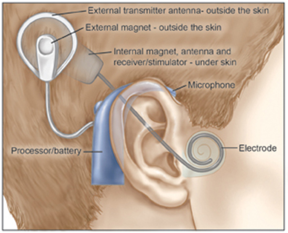 Cochlear Implants Approved